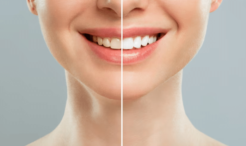 Brighten Your Smile- Teeth Whitening Tips & Tricks for Sensitive Teeth