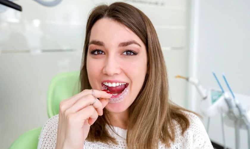 The Ultimate Guide To Maintaining Your Invisalign Aligners